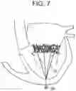Fig. 07 - Truncated cone heart valve stent