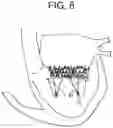 Fig. 08 - Truncated cone heart valve stent