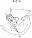 Fig. 09 - Truncated cone heart valve stent