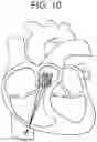 Fig. 10 - Truncated cone heart valve stent