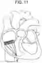 Fig. 11 - Truncated cone heart valve stent