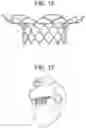 Fig. 12 - Truncated cone heart valve stent