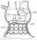 Fig. 01 - System and method for implanting and securing a bioprosthetic device to wet tissue