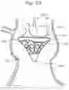 Fig. 10 - System and method for implanting and securing a bioprosthetic device to wet tissue
