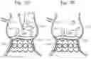 Fig. 12 - System and method for implanting and securing a bioprosthetic device to wet tissue