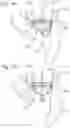 Fig. 22 - System and method for implanting and securing a bioprosthetic device to wet tissue