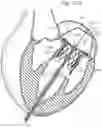 Fig. 29 - System and method for implanting and securing a bioprosthetic device to wet tissue