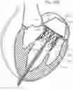 Fig. 30 - System and method for implanting and securing a bioprosthetic device to wet tissue