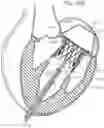 Fig. 32 - System and method for implanting and securing a bioprosthetic device to wet tissue