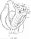 Fig. 20 - Methods and apparatus for delivering a prosthetic valve to a beating heart