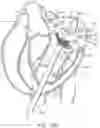 Fig. 22 - Methods and apparatus for delivering a prosthetic valve to a beating heart
