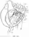 Fig. 25 - Methods and apparatus for delivering a prosthetic valve to a beating heart