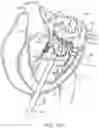 Fig. 26 - Methods and apparatus for delivering a prosthetic valve to a beating heart