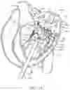 Fig. 27 - Methods and apparatus for delivering a prosthetic valve to a beating heart