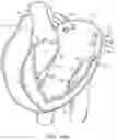 Fig. 31 - Methods and apparatus for delivering a prosthetic valve to a beating heart