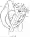 Fig. 32 - Methods and apparatus for delivering a prosthetic valve to a beating heart