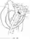 Fig. 33 - Methods and apparatus for delivering a prosthetic valve to a beating heart