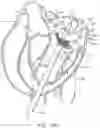 Fig. 34 - Methods and apparatus for delivering a prosthetic valve to a beating heart