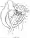 Fig. 35 - Methods and apparatus for delivering a prosthetic valve to a beating heart