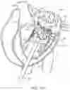 Fig. 38 - Methods and apparatus for delivering a prosthetic valve to a beating heart