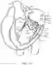 Fig. 40 - Methods and apparatus for delivering a prosthetic valve to a beating heart