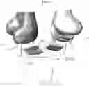 Fig. 07 - Early Intervention Knee Implant Device and Methods