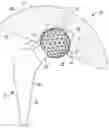 Fig. 01 - Adjustable orthopedic connections