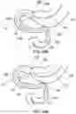 Fig. 50 - DELIVERY DEVICES AND METHODS FOR GASTROINTESTINAL IMPLANTS