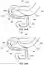 Fig. 55 - DELIVERY DEVICES AND METHODS FOR GASTROINTESTINAL IMPLANTS