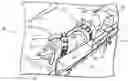 Fig. 01 - Arm restraint for surgery tables