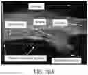 Fig. 33 - Scleral translocation elasto-modulation methods and apparatus