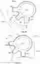 Fig. 35 - DEVICE AND METHOD FOR INTRAOCULAR DRUG DELIVERY