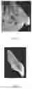 Fig. 03 - DENTAL TREATMENT METHOD AND ABUTMENT USED THEREIN