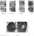Fig. 06 - Aggregating microparticles for medical therapy