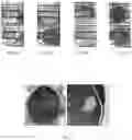 Fig. 06 - Aggregating microparticles for medical therapy