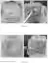 Fig. 07 - Aggregating microparticles for medical therapy