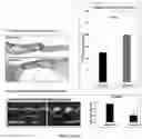 Fig. 03 - Methods for treating aortic valve stenosis with a hedgehog pathway inhibitor