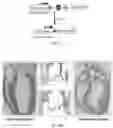 Fig. 04 - Methods for treating aortic valve stenosis with a hedgehog pathway inhibitor