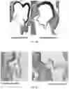 Fig. 05 - Methods for treating aortic valve stenosis with a hedgehog pathway inhibitor