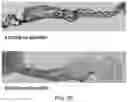 Fig. 06 - Methods for treating aortic valve stenosis with a hedgehog pathway inhibitor