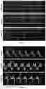 Fig. 08 - Methods for treating aortic valve stenosis with a hedgehog pathway inhibitor