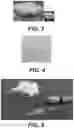 Fig. 04 - Methods of treating tissue voids following removal of implantable infusion ports using adipose tissue products