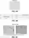 Fig. 07 - Methods of treating tissue voids following removal of implantable infusion ports using adipose tissue products