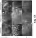Fig. 09 - Methods of treating tissue voids following removal of implantable infusion ports using adipose tissue products