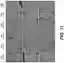Fig. 10 - Methods of treating tissue voids following removal of implantable infusion ports using adipose tissue products