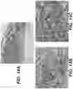 Fig. 13 - Methods of treating tissue voids following removal of implantable infusion ports using adipose tissue products