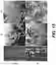 Fig. 14 - Methods of treating tissue voids following removal of implantable infusion ports using adipose tissue products