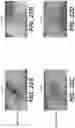 Fig. 21 - Methods of treating tissue voids following removal of implantable infusion ports using adipose tissue products