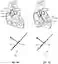 Fig. 08 - Aortic valve no exchange catheter and methods of using the same