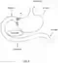 Fig. 05 - Systems, devices and methods for the creation of a therapeutic restriction in the gastrointestinal tract